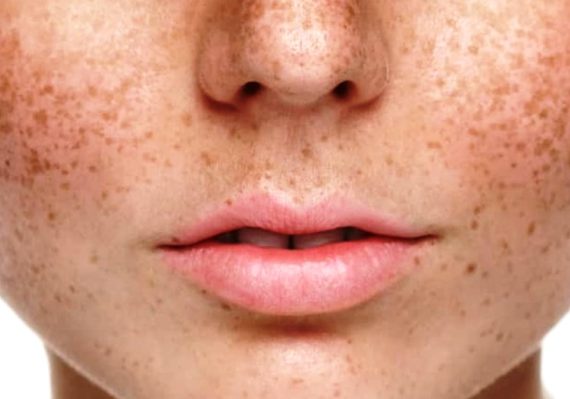 Cara Menghilangkan Bintik Hitam di Wajah dengan Bahan Alami
